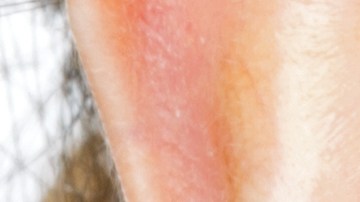 enfermedades-dermatologicas