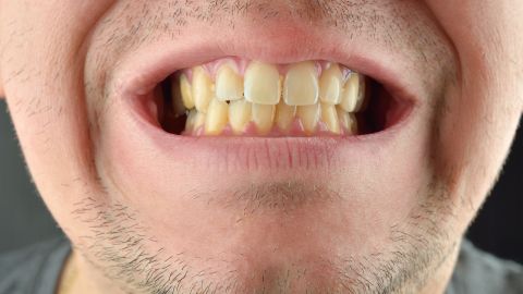 dientes amarillos