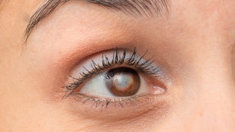 cataratas ojos