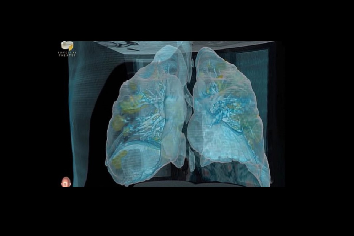 Así se aprecian los pulmones en el video.