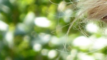 Un melanoma es un tipo de cáncer de piel que puede comenzar en un lunar. Detectado temprano, el melanoma es altamente tratable.