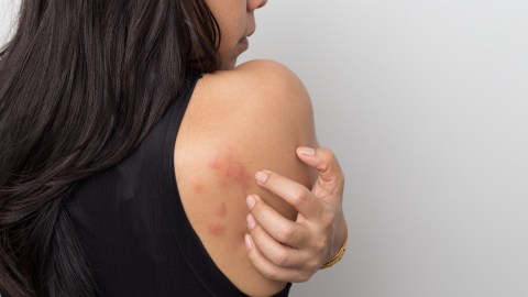 urticaria piel
