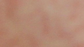 Declaran finalizado brote de sarampión en Texas, pero reportan otro caso en Colorado