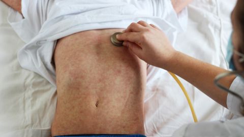Brote de sarampión en Texas supera los 300 casos