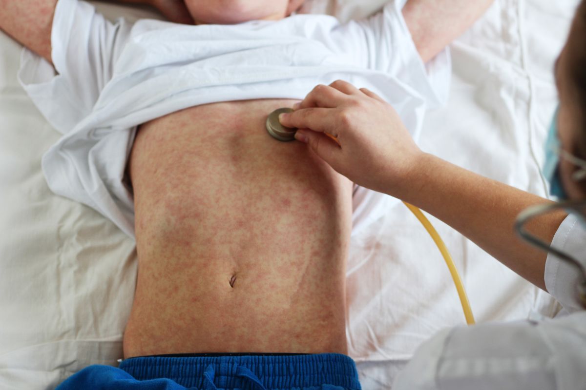 ¿Cuánto tiempo dura el sarampión y cómo podemos tratarlo?