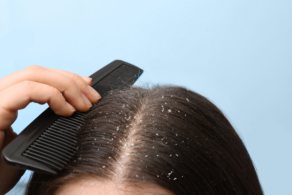 3 shampoos por menos de $10 dólares para quitar la caspa y alivian la irritación en el cuero cabelludo | La Opinión 3 shampoos por menos de $10 dólares para quitar la caspa y alivian la irritación en el cuero cabelludo | La Opinión
