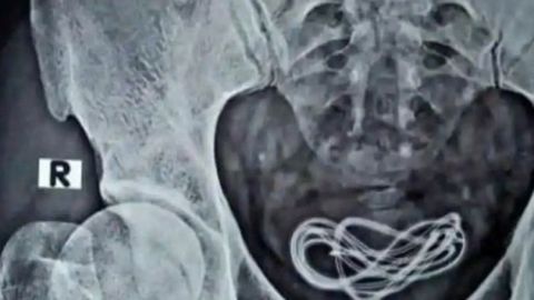 El paciente acudió con dolor porque se había insertado un cable por el pene.