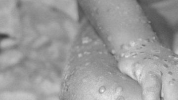 La enfermedad producía una característica erupción en la piel.