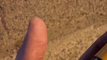 Heridas por las pelotas de goma que lanzan los policías a los manifestantes. (Cortesía)