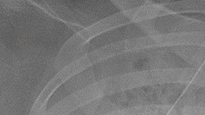 El daño en los pulmones era irreversible.