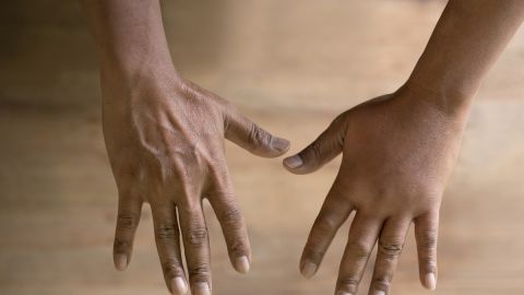 dedos hinchados