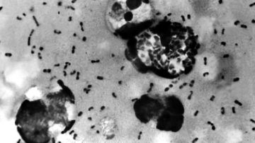 La peste bubónica se caracteriza por la inflamación de los ganglios linfáticos