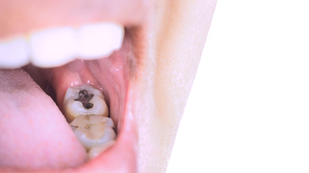 amalgama dientes