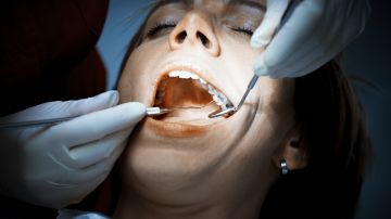 amalgama dientes odontología