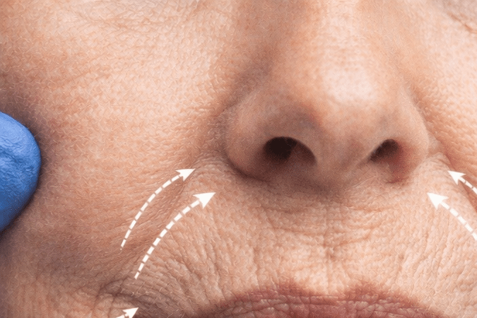 Primer plano de arrugas alrededor de la boca y tratamiento estético con relleno facial
