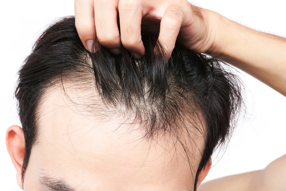 3 que sirven tratar la caída del cabello en hombres - La Opinión