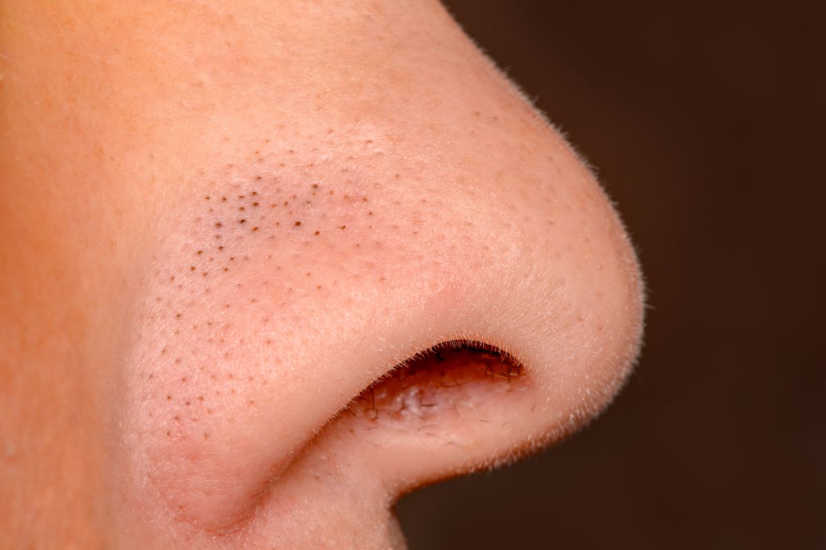 5 para eliminar los puntos negros de tu nariz sin dolor - La Opinión