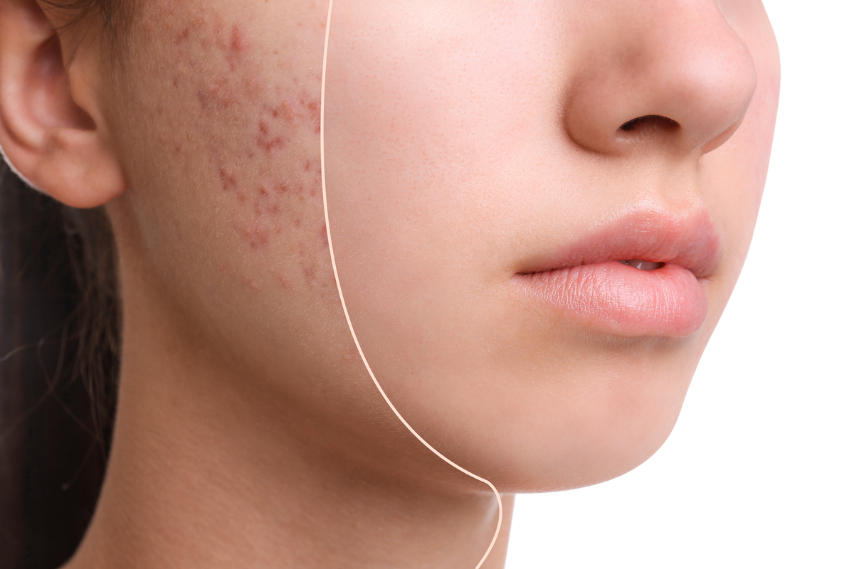 Los mejores kits de productos especiales para evitar el acné en tu rostro -  La Opinión