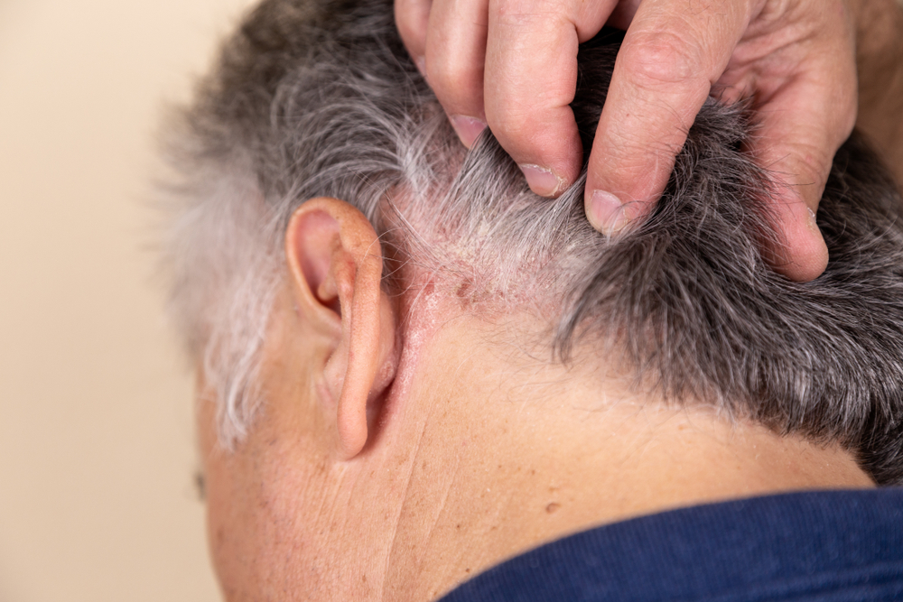 Cuero cabelludo reseco y escamoso? 3 productos que alivian esta condición y  reparan el cabello - La Opinión