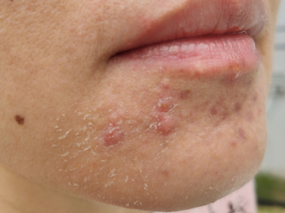 3 jabones eliminar la dermatitis seborreica la cara sin resecarla -