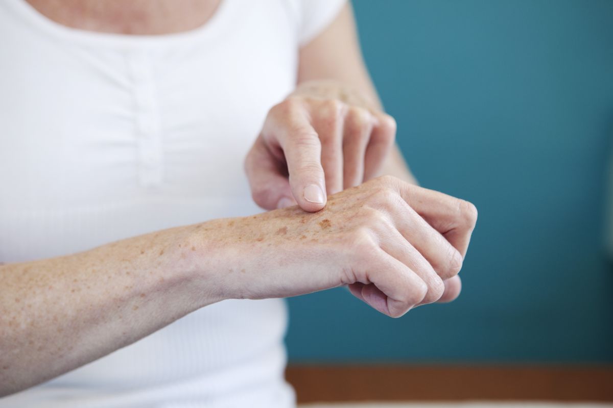 Las manchas en la piel son uno de los principales signos del envejecimiento