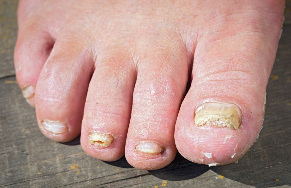 ¿Cómo quitar el hongo de las uñas de los pies? | La Opinión