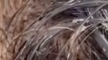 VIDEO: Niña es invadida por cientos de piojos