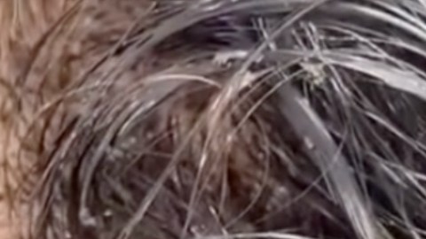 VIDEO: Niña es invadida por cientos de piojos