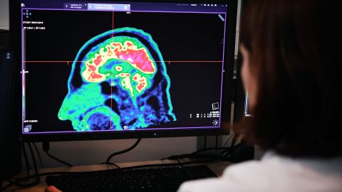 A migrante le detectaron una solitaria que tenía alojada en el cerebro desde hace décadas