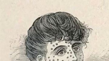 La misteriosa "amnesia inmunológica" causada por el sarampión (y cómo puede afectar la protección contra el coronavirus)