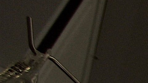 Madre de dos hijos muere después de una operación de liposucción fallida en España