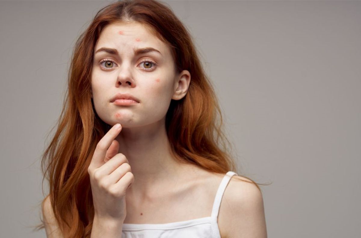 El acné es más común en adolescentes debido a los cambios hormonales