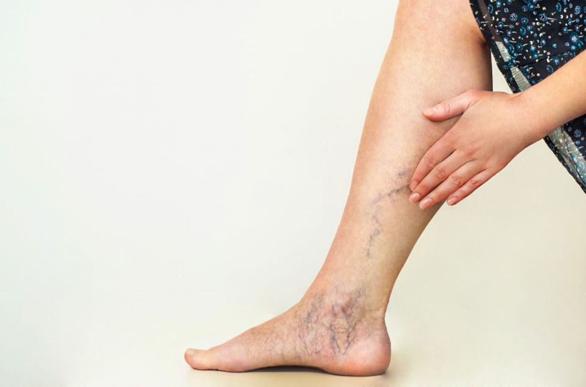 Las várices pueden causar o molestias en las piernas