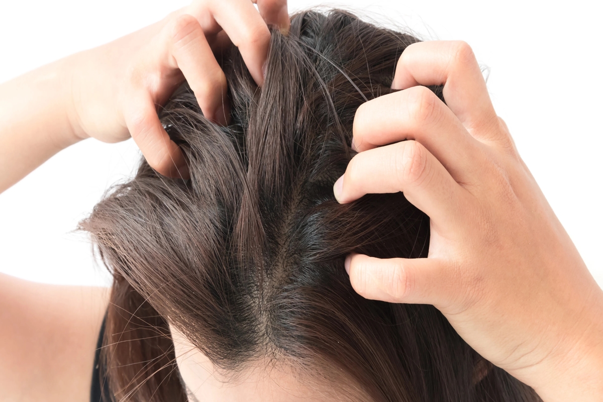Ligero Puñalada elección Qué hacer para eliminar los granos en el cuero cabelludo - La Opinión