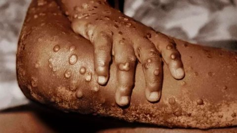 Viruela del mono: qué es esta enfermedad detectada en Europa y Norteamérica y qué riesgos entraña para la salud