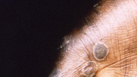 La OMS anticipa que aparecerán más casos de la viruela del mono