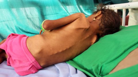 El mundo se está convirtiendo en “un polvorín” de la desnutrición infantil: UNICEF