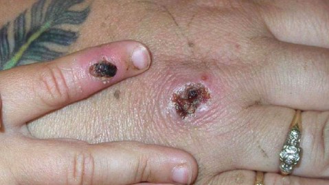 UNDATED ? JUNE 5: In this Centers for Disease Control and Prevention handout graphic, symptoms of one of the first known cases of the monkeypox virus are shown on a patient?s hand June 5, 2003. The CDC said the viral disease monkeypox, thought to be spread by prairie dogs, has been detected in the Americas for the first time with about 20 cases reported in Wisconsin, Illinois, and Indiana. (Photo Courtesy of CDC/Getty Images)