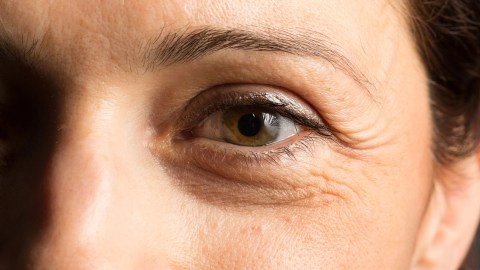 arrugas en los ojos
