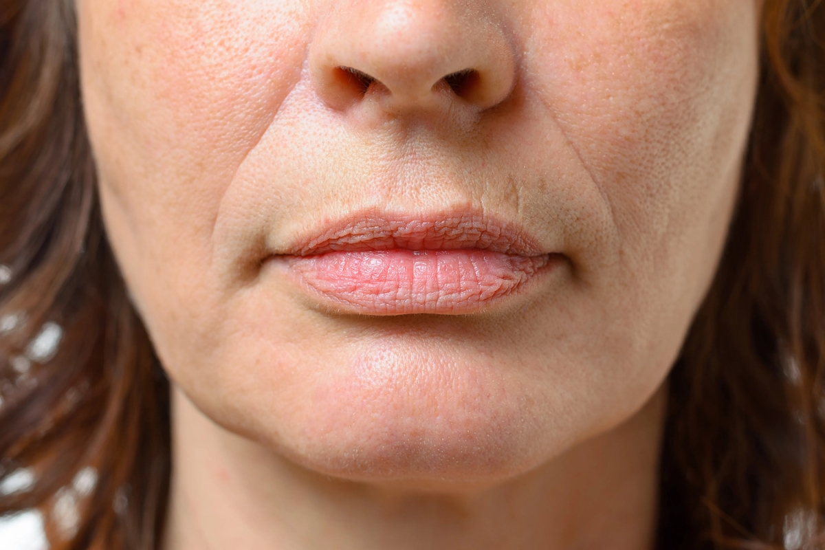 Normalmente a los 35-40 años el surco nasogeniano se acentúa en el rostro si no se previene.