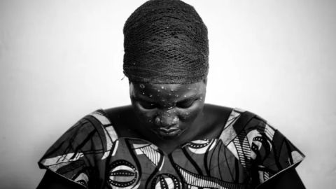Se han reportado casos de viruela del mono por años en África.