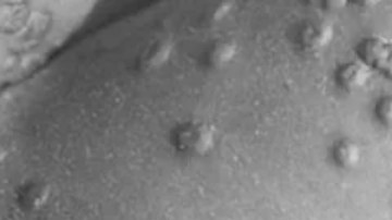 La viruela humana es una de las enfermedades más letales.