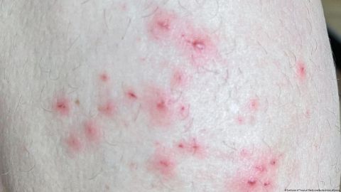 OMS reporta 780 casos de viruela del mono, la mayoría en Europa