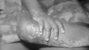 BONDUA, LIBERIA - UNDATED: In this 1971 Center For Disease Control handout photo, monkeypox-like lesions are shown on the arm and leg of a female child in Bondua, Liberia. The Centers for Disease Control and Prevention said June 7 the viral disease monkeypox, thought to be spread by prairie dogs, has been detected in the Americas for the first time with about 20 cases reported in Wisconsin, Illinois, and Indiana. (Photo Courtesy of the CDC/Getty Images)