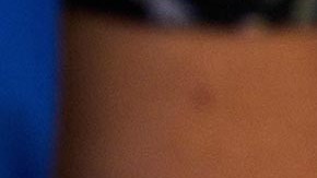 El 98% de los casos que han sido detectados es entre hombres que tienen relaciones sexuales con hombres.