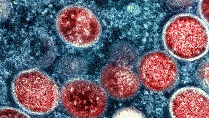 India confirma muerte de un hombre contagiado con viruela del mono