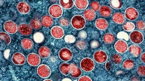 India confirma muerte de un hombre contagiado con viruela del mono
