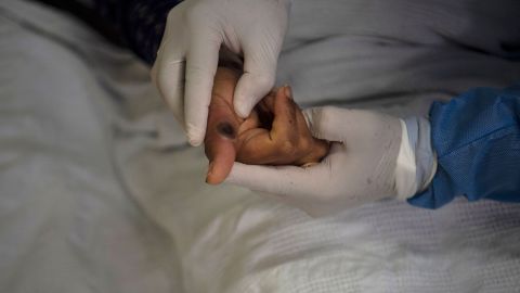 Texas confirma primera muerte en EE.UU. por viruela del mono en paciente gravemente inmunocomprometido