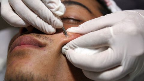 Hombre descubre que el barro que no se le quitaba de la cara era un tumor