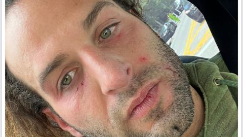 Miguel Mawad con el rostro como le habría quedado después de la supuesta pelea con Aleska